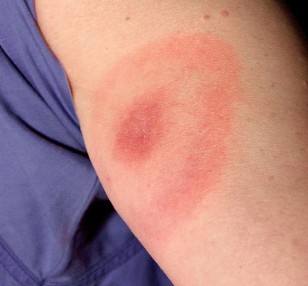 Borreliose Symptome erkennen Schlimme Spätfolgen vermeiden.